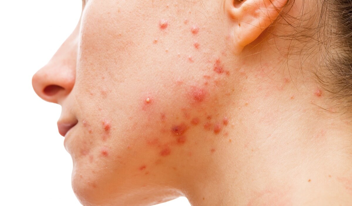 rimedi naturali macchie acne