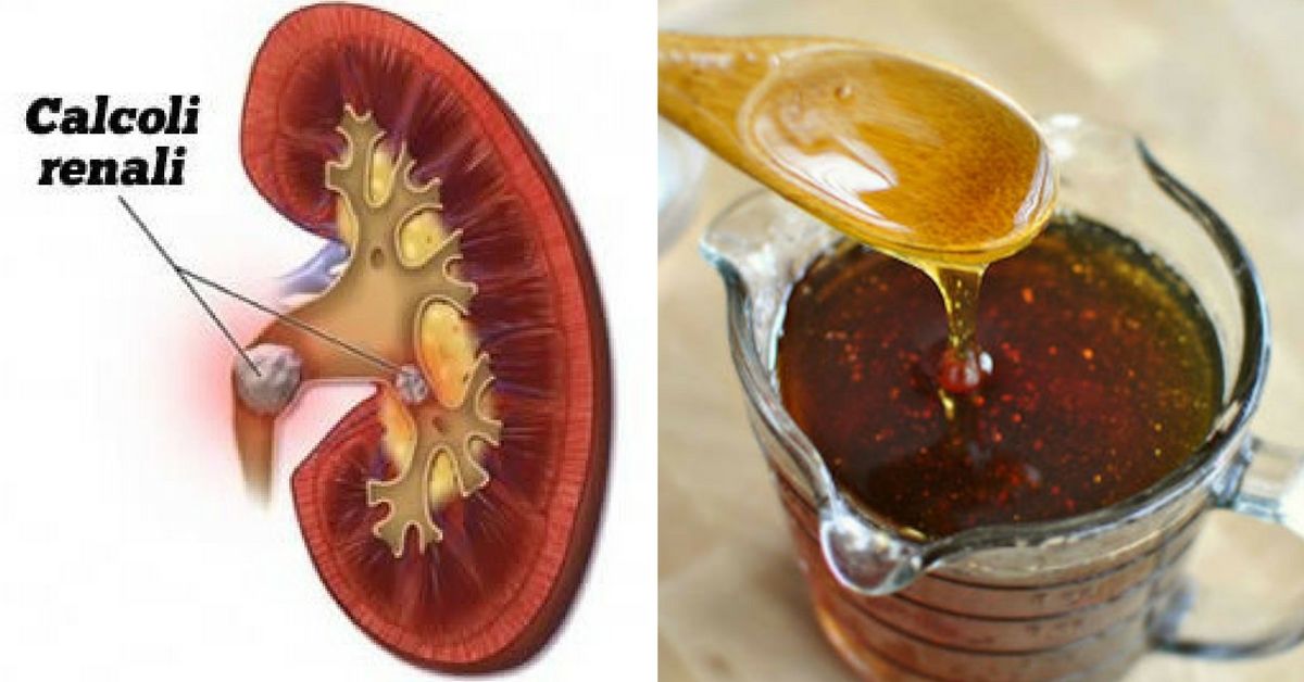 Come sciogliere i calcoli renali in modo naturale Evoluzione Collettiva