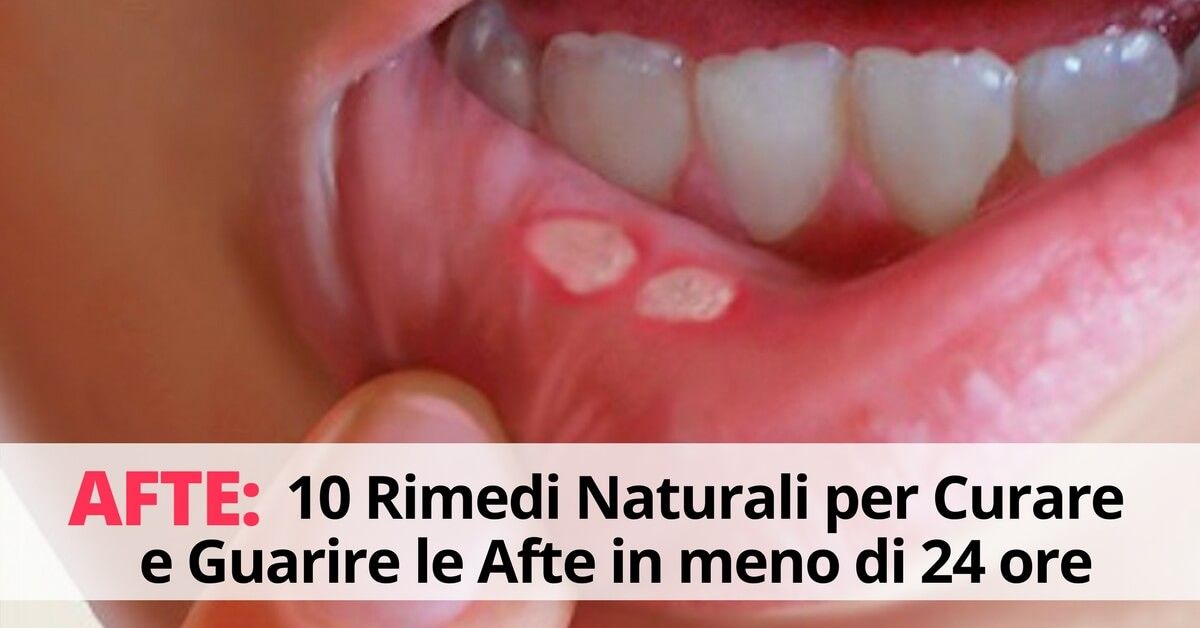 Afte 10 rimedi naturali per curarle EvoluzioneCollettiva