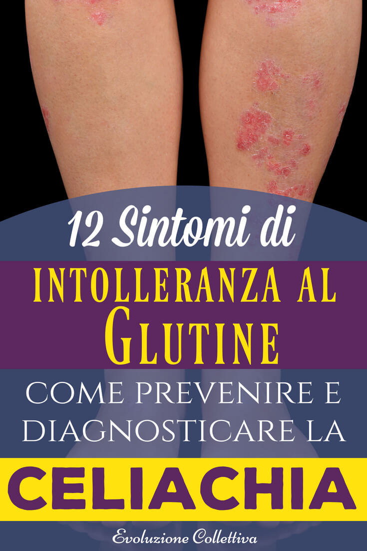 Sintomi di Intolleranza al glutine (celiachia) e cosa mangiare
